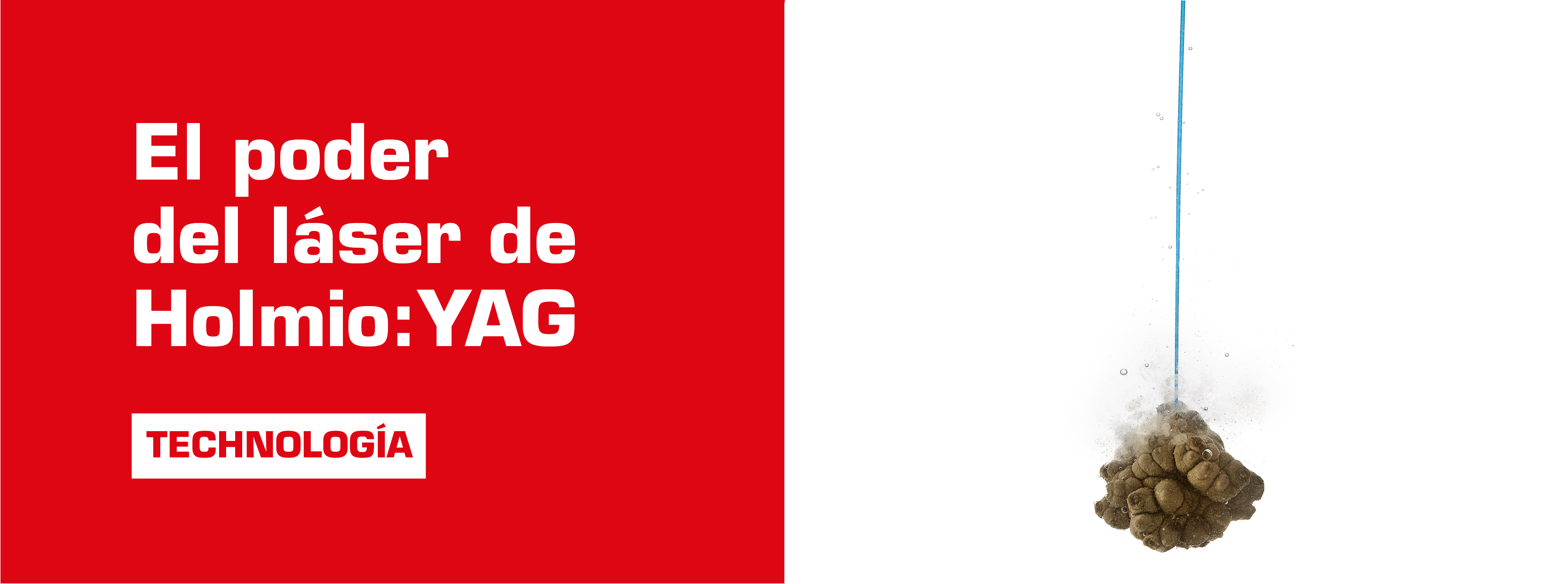 HolmiumYAG Laser technology EMS Urology